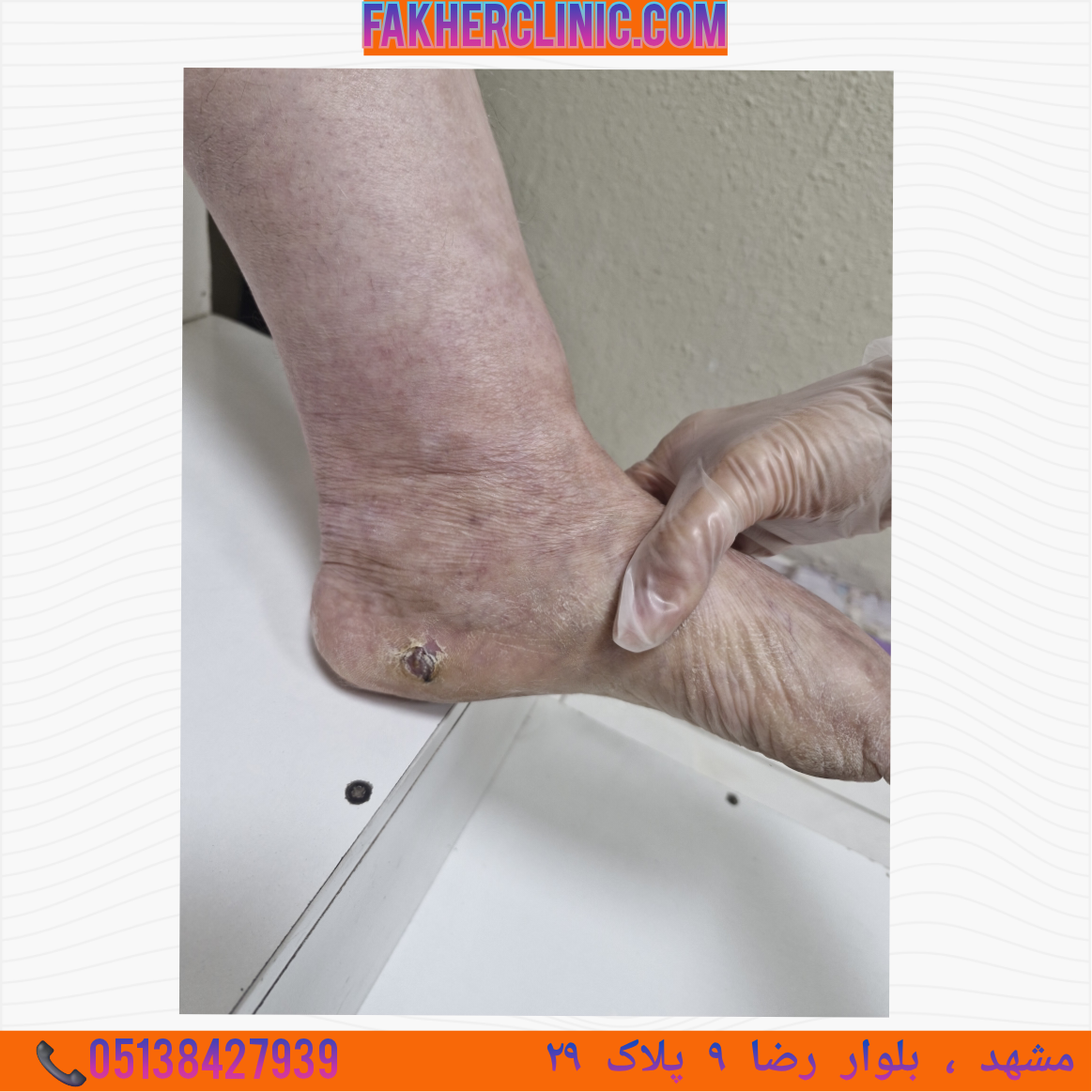 تصویر زخم دیابتی
