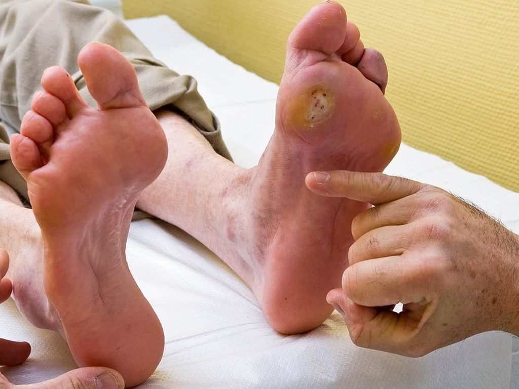 تصویر زخم پای دیابتی