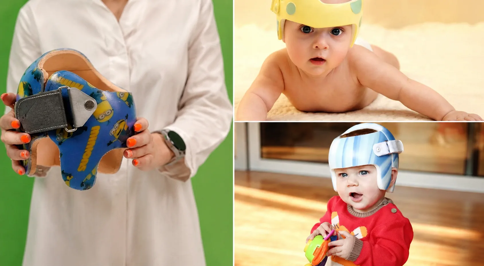 استفاده از کلاه فرم‌دهنده helmet therapy​