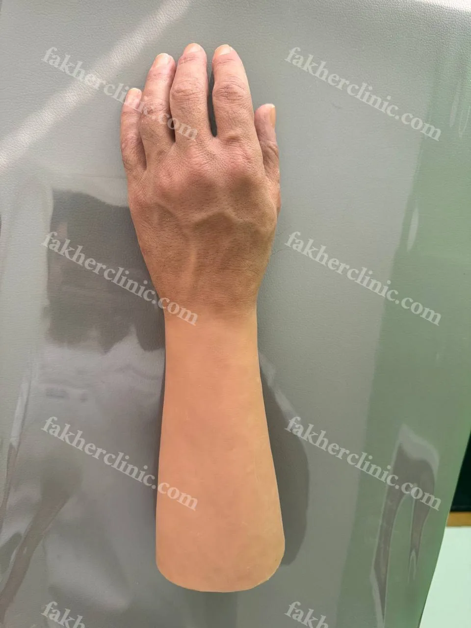 پروتز سیلیکونی دست مشهد