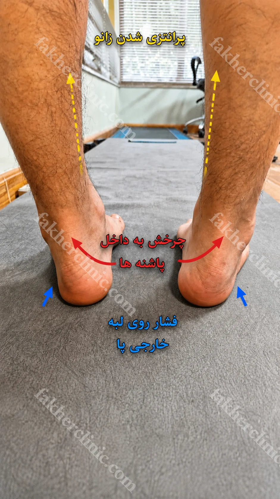 عوارض قوس زیاد پا در مشهد