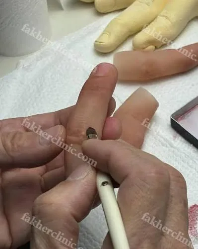مراقبت از پروتز انگشت