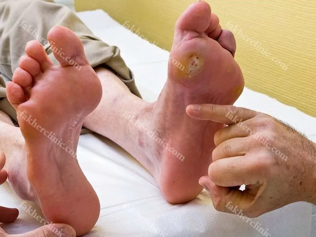 زخم پای دیابتی