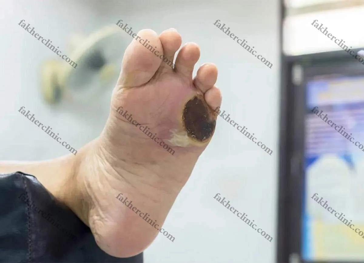 زخم پای دیابتی